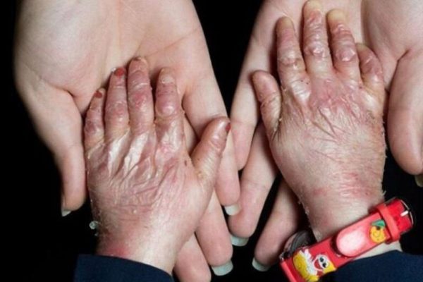 تسلی‌بخشی شعر بر درد بیماران پروانه‌ای