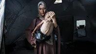 سوء تغذیه شدید در کودکان زیر ۵ سال در شهر غزه سه برابر شده است