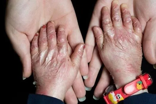 مستندسازی آثار تحریم‌ها بر بیماران خاص در ستاد حقوق بشر